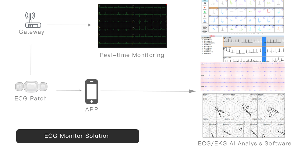 Remote ECG/EKG monitor  and analysis solution