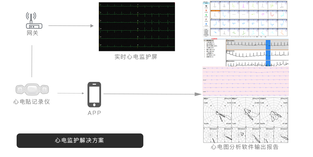 Remote ECG/EKG monitor  and analysis solution